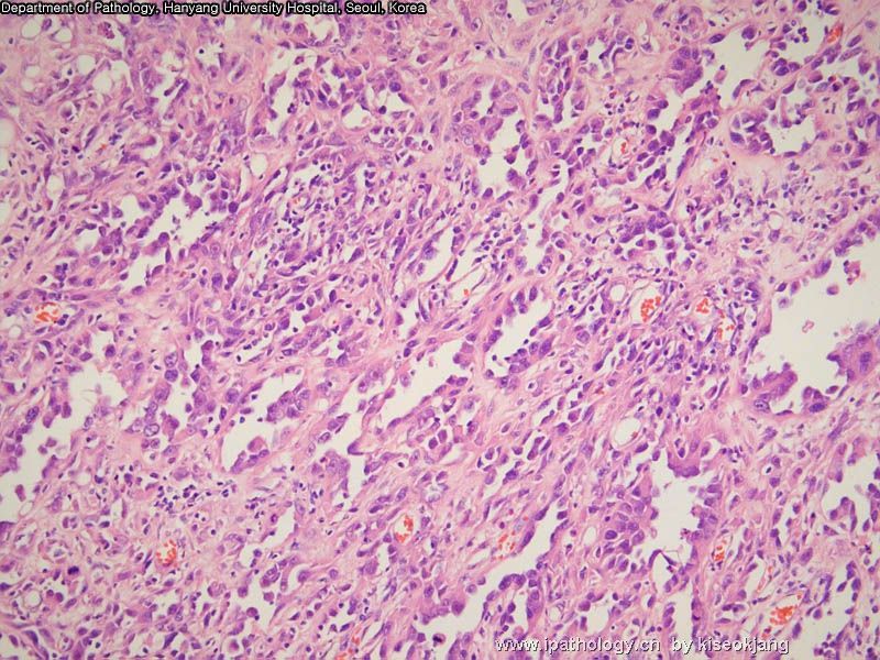 HYUH Case 1 What is your diagnosis? (pleural mass)图4