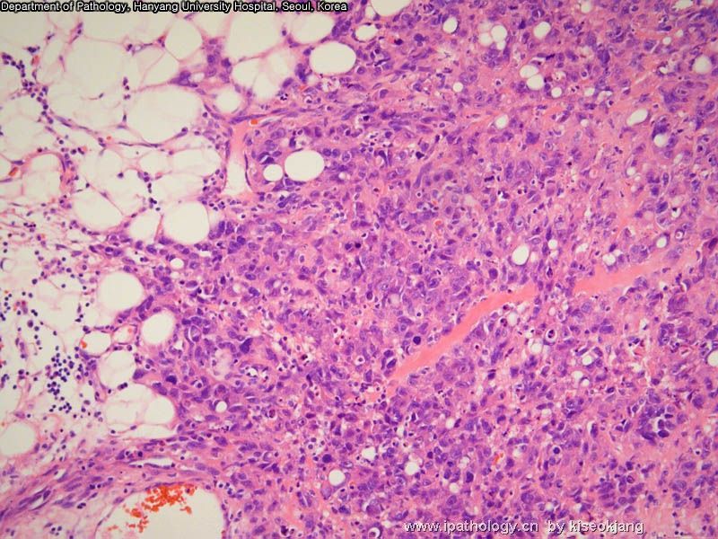 HYUH Case 1 What is your diagnosis? (pleural mass)图5