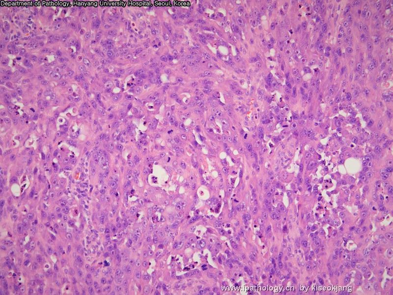 HYUH Case 1 What is your diagnosis? (pleural mass)图6