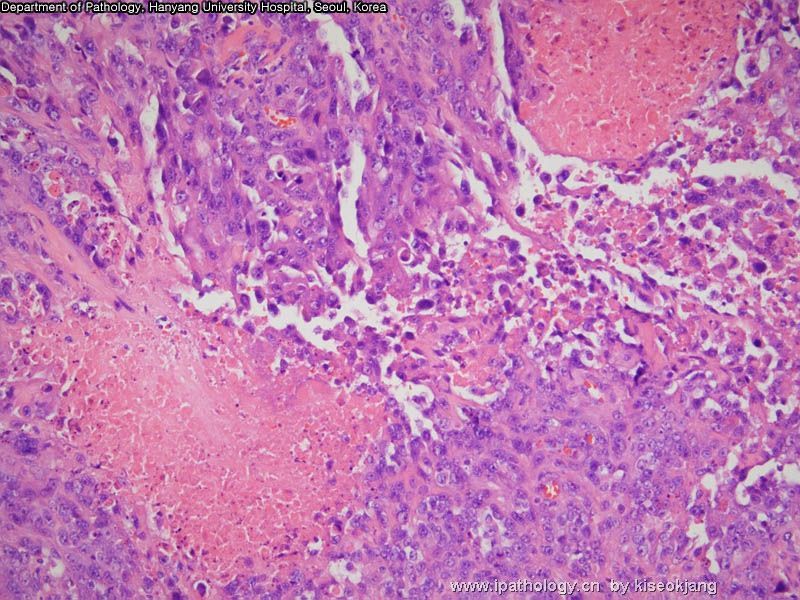 HYUH Case 1 What is your diagnosis? (pleural mass)图7