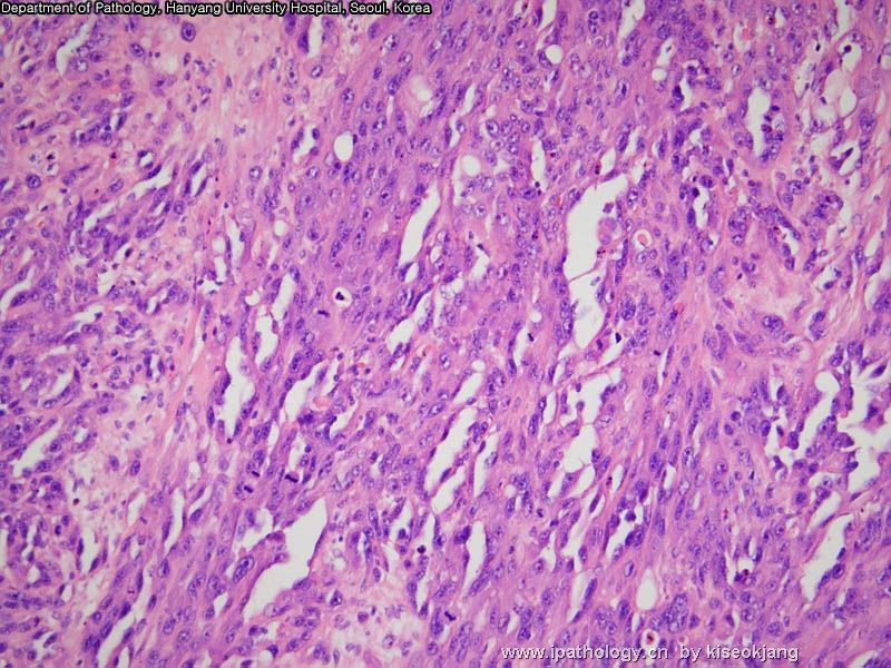 HYUH Case 1 What is your diagnosis? (pleural mass)图9