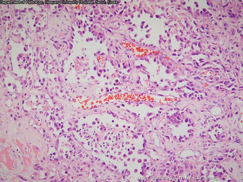 HYUH Case 1 What is your diagnosis? (pleural mass)图10