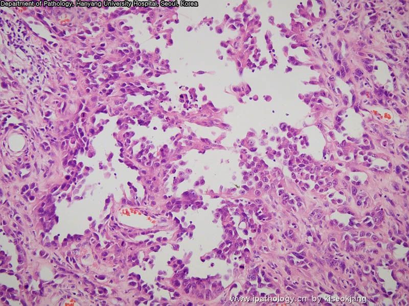 HYUH Case 1 What is your diagnosis? (pleural mass)图11