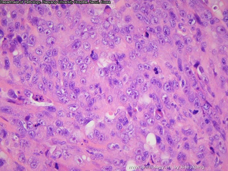 HYUH Case 1 What is your diagnosis? (pleural mass)图12