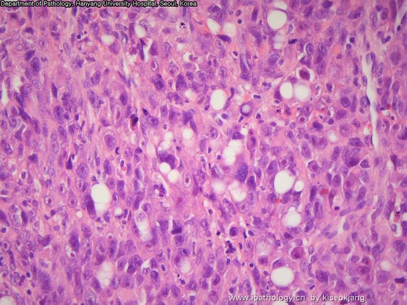 HYUH Case 1 What is your diagnosis? (pleural mass)图13