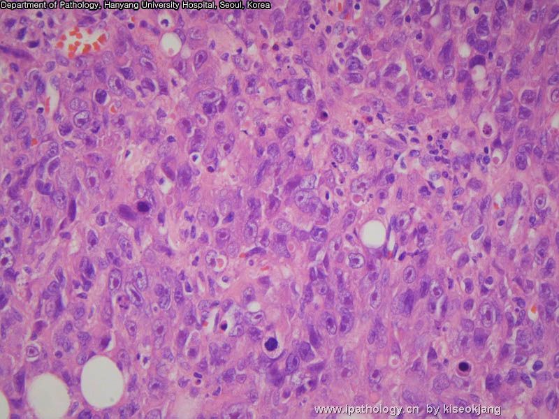 HYUH Case 1 What is your diagnosis? (pleural mass)图14