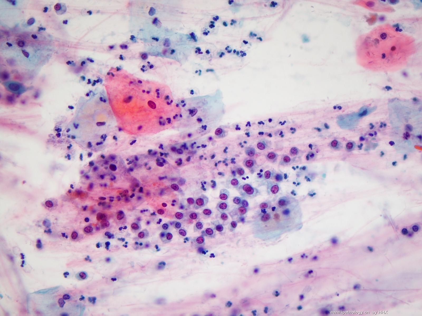 宫颈细胞学，那些小圆细胞是什么？（已附加组织细胞的图谱）图2