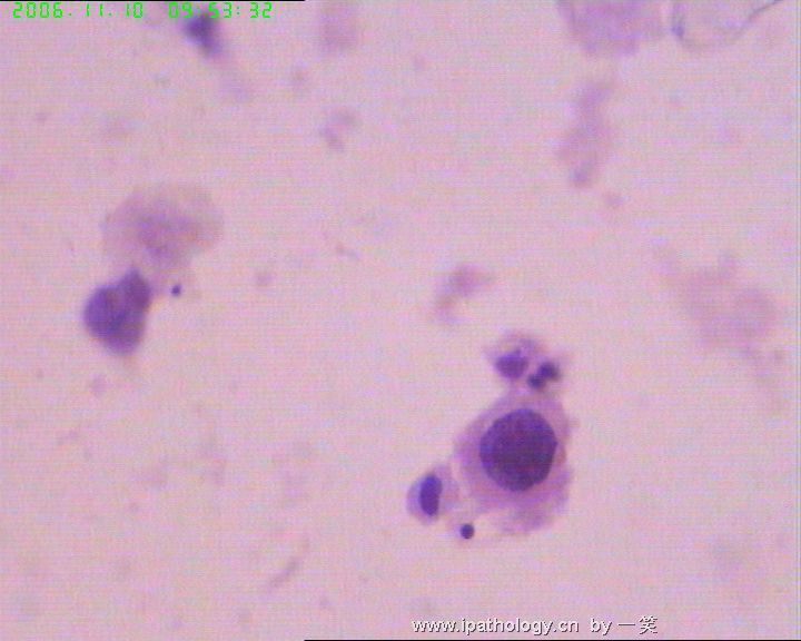 31岁，宫颈Ⅲ度糜烂，涂片图3