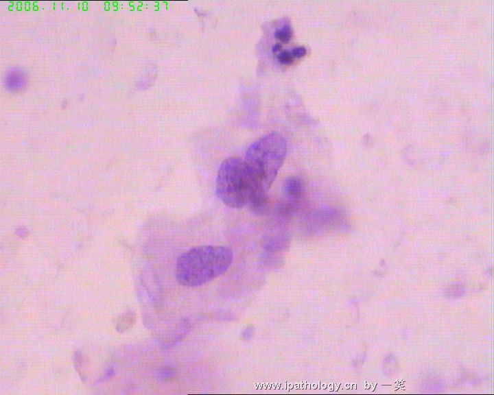 31岁，宫颈Ⅲ度糜烂，涂片图2