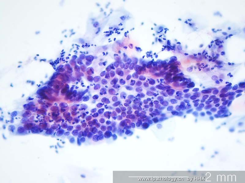 Teaching case(cervical cytology).What is your diagnosis?图1