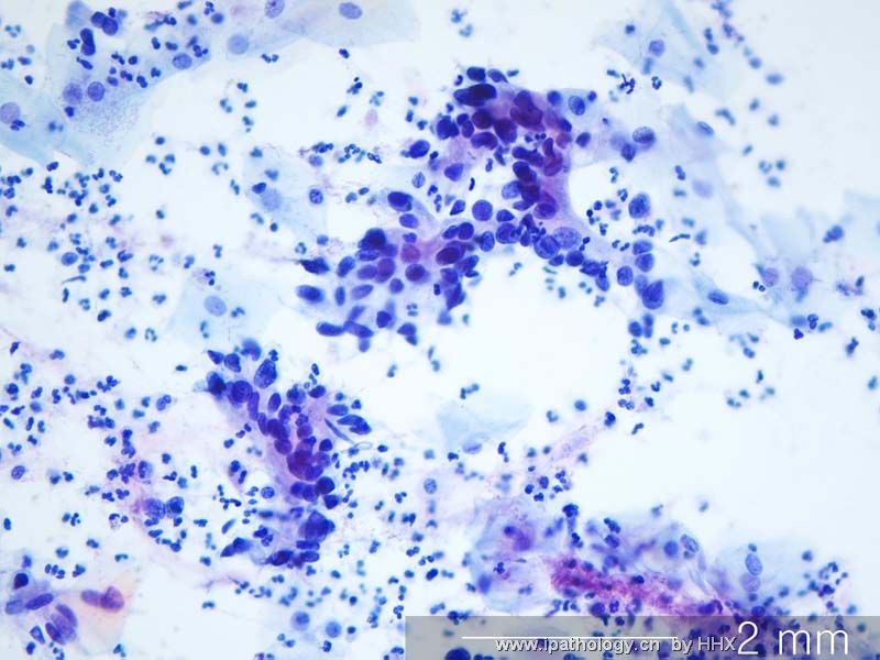Teaching case(cervical cytology).What is your diagnosis?图2