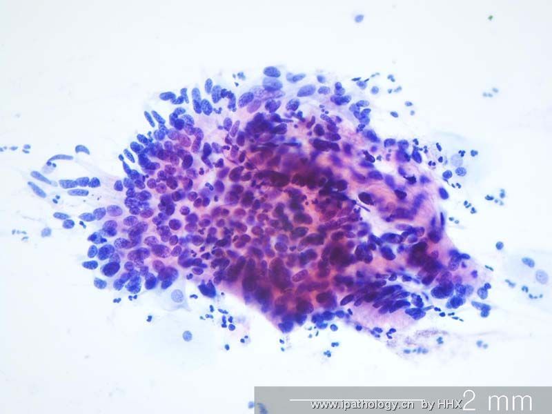 Teaching case(cervical cytology).What is your diagnosis?图3