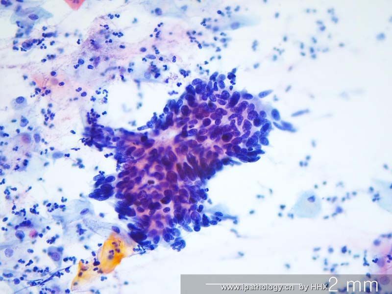 Teaching case(cervical cytology).What is your diagnosis?图4