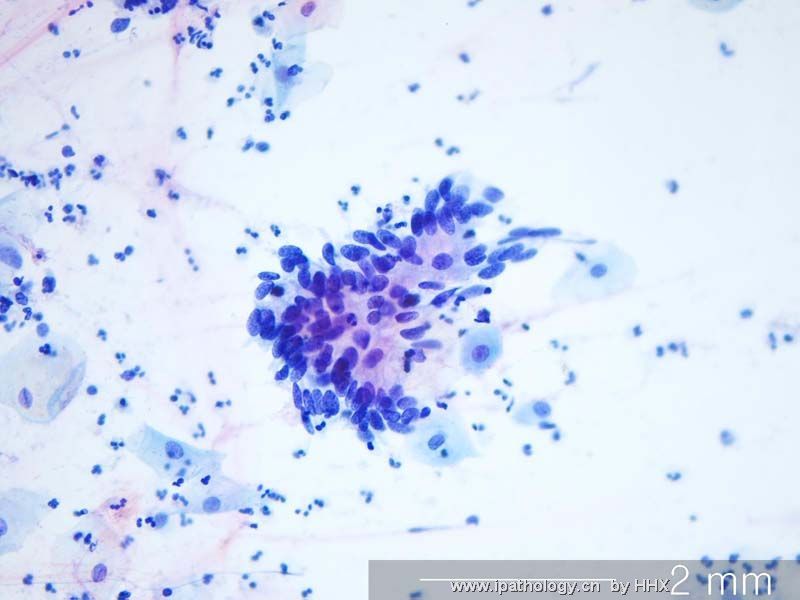 Teaching case(cervical cytology).What is your diagnosis?图5