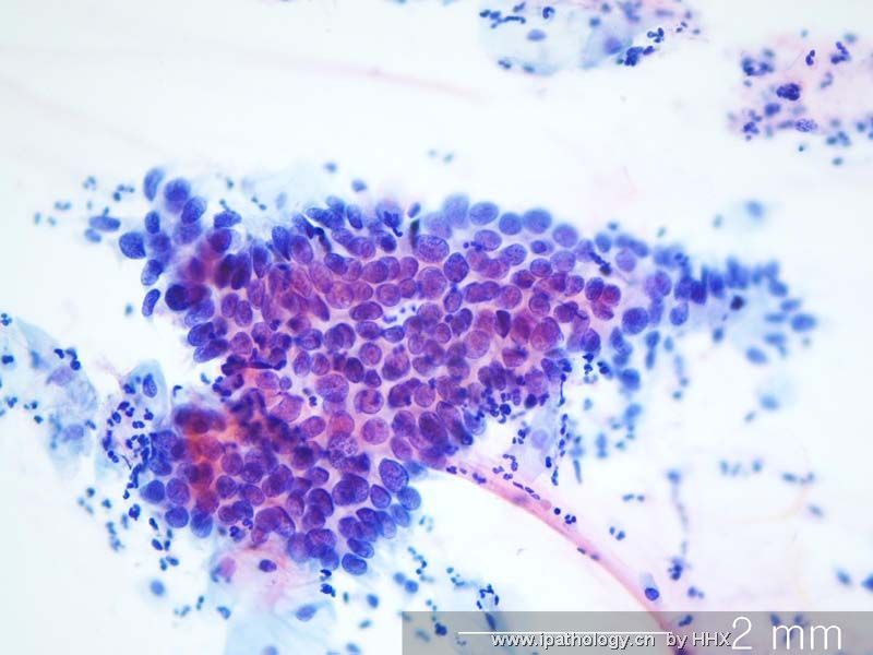Teaching case(cervical cytology).What is your diagnosis?图6