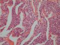 胃肿瘤－－血管球瘤图2