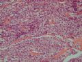 胃肿瘤－－血管球瘤图3