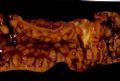 Crohn 病的大体和镜下，肠镜下的小标本，Fistular CD,appendix CD.图5