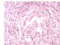 乳腺肿物－－化生性癌图7