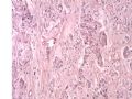 乳腺肿物－－化生性癌图10