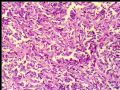 右肾肿瘤－－低度恶性孤立性纤维性肿瘤图5