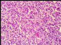 右肾肿瘤－－低度恶性孤立性纤维性肿瘤图6