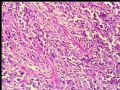 右肾肿瘤－－低度恶性孤立性纤维性肿瘤图7
