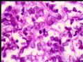 右肾肿瘤－－低度恶性孤立性纤维性肿瘤图9