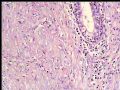 左乳复发性肿块--梭型细胞癌图2