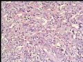 左乳复发性肿块--梭型细胞癌图3