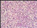 左乳复发性肿块--梭型细胞癌图4