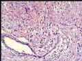 左乳复发性肿块--梭型细胞癌图5