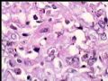 左乳复发性肿块--梭型细胞癌图6