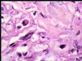 左乳复发性肿块--梭型细胞癌图7