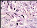 左乳复发性肿块--梭型细胞癌图8