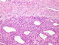 （转贴）股部软组织肿瘤--肌周细胞瘤(myopericytoma)图1