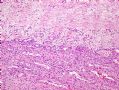 （转贴）股部软组织肿瘤--肌周细胞瘤(myopericytoma)图2