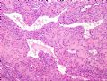 （转贴）股部软组织肿瘤--肌周细胞瘤(myopericytoma)图3