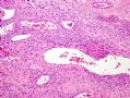 （转贴）股部软组织肿瘤--肌周细胞瘤(myopericytoma)图4