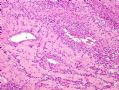 （转贴）股部软组织肿瘤--肌周细胞瘤(myopericytoma)图5