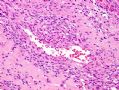 （转贴）股部软组织肿瘤--肌周细胞瘤(myopericytoma)图6
