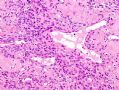（转贴）股部软组织肿瘤--肌周细胞瘤(myopericytoma)图7