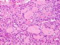 （转贴）股部软组织肿瘤--肌周细胞瘤(myopericytoma)图8