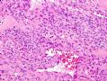（转贴）股部软组织肿瘤--肌周细胞瘤(myopericytoma)图9