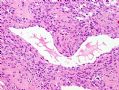 （转贴）股部软组织肿瘤--肌周细胞瘤(myopericytoma)图10