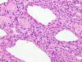 （转贴）股部软组织肿瘤--肌周细胞瘤(myopericytoma)图11