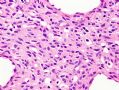 （转贴）股部软组织肿瘤--肌周细胞瘤(myopericytoma)图12