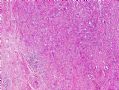 （转贴）足背软组织肿块-----retiform hemangioendothelioma图1