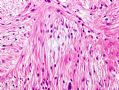 (转贴)颈后软组织肿物－－肌内粘液瘤(intramuscular myxoma)图9