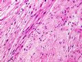 (转贴)颈后软组织肿物－－肌内粘液瘤(intramuscular myxoma)图10